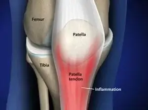 Tendonitis Patellar punca sakit lutut di usia muda