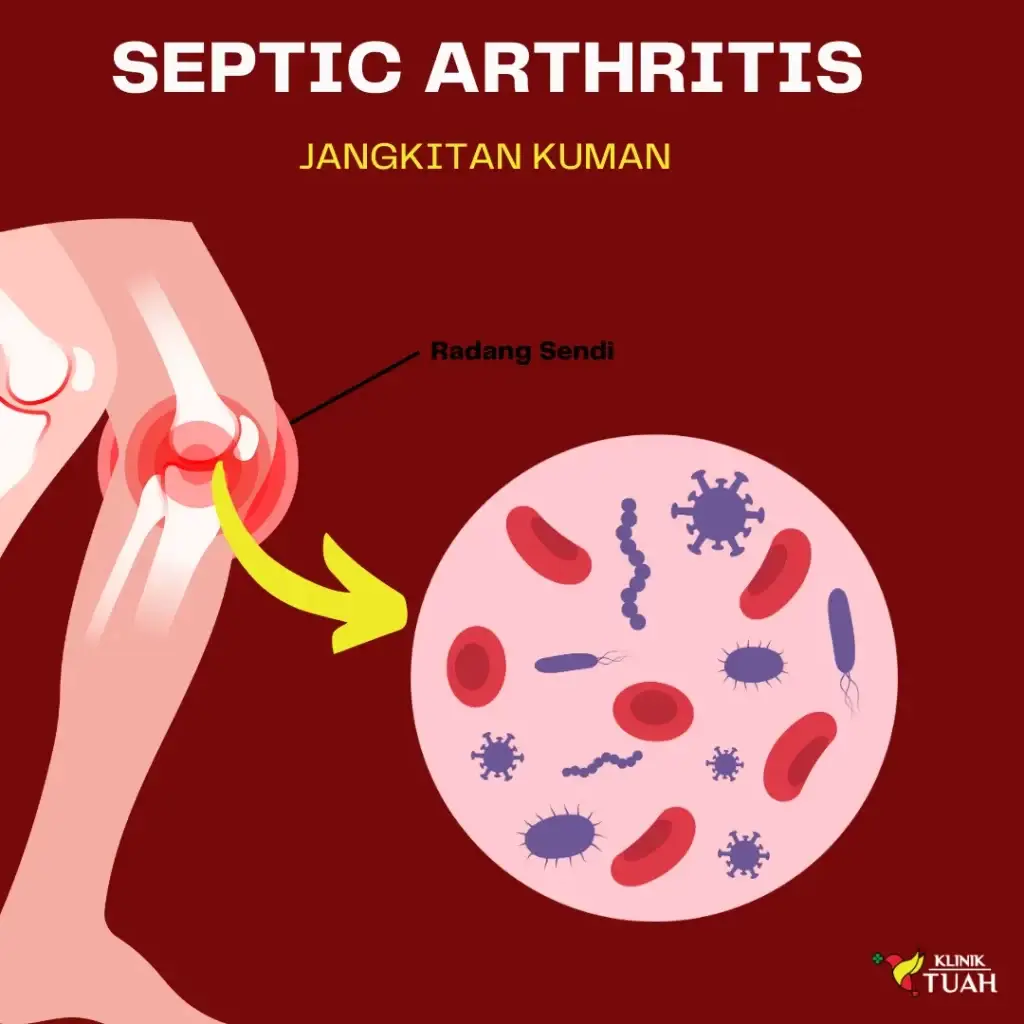 septic arthritis punca sakit lutut tiba-tiba