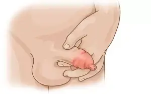infection can be risk of stapler circumcision