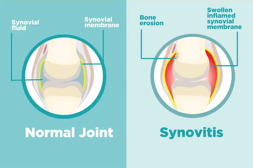 synovitis antara kesan sampingan suntikan gel lutut