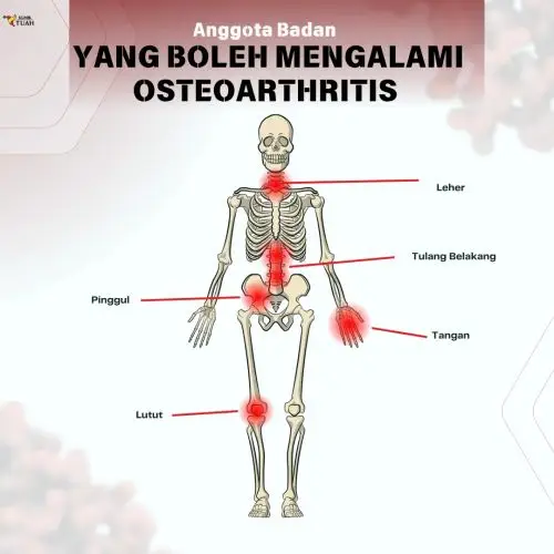 sendi yang berpotensi mengalami tanda awal arthritis osteoarthritis