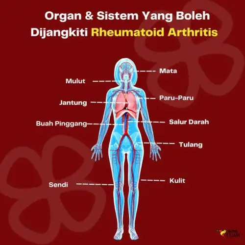 sendi yang berpotensi mengalami tanda awal arthritis rheumatoid arthritis