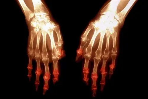 sakit sendi pada kedua-dua belah tangan antara tanda awal arthritis jenis rheumatoid