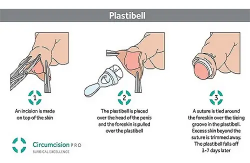 kaedah plastibell di bawah artikel tips khatan bayi