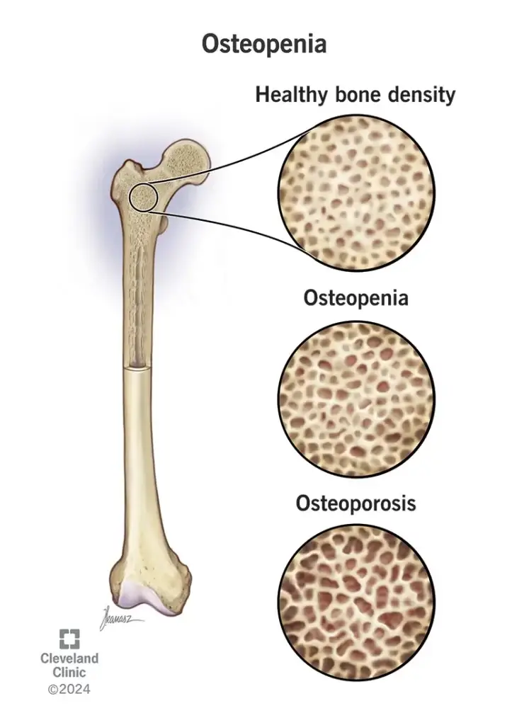 osteopenia di bawah artikel vitamin untuk lutut