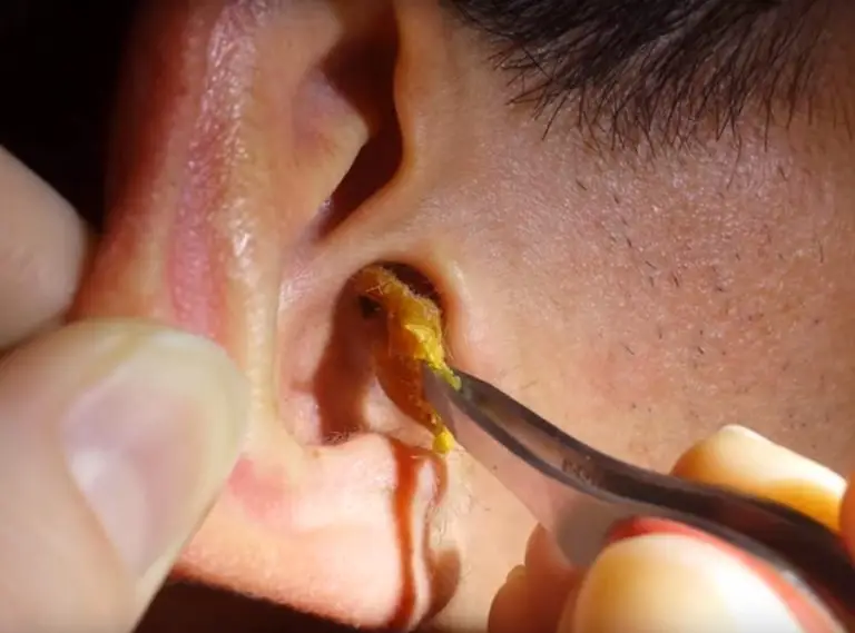 Removing earwax can restore hearing