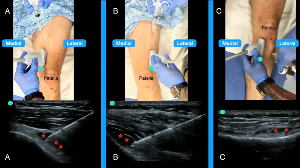 Apa Itu Genicular Nerve Block (GNB)? Untuk Sakit Lutut Kronik