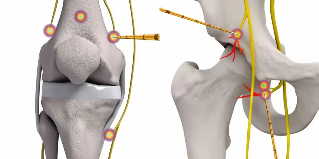 Rawatan Rba Radiofrequency Ablation (RFA): Harapan Sakit Lutut Kronik