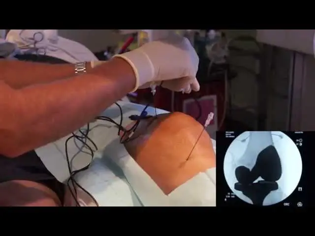 Rawatan Rba Radiofrequency Ablation (RFA): Harapan Sakit Lutut Kronik