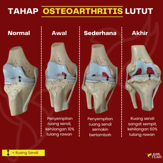 Rawatan Rba Radiofrequency Ablation (RFA): Harapan Sakit Lutut Kronik